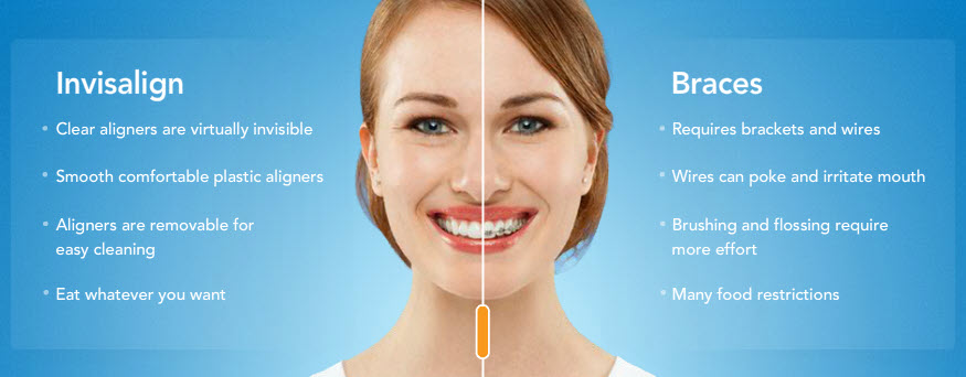 invisalignvsbraces