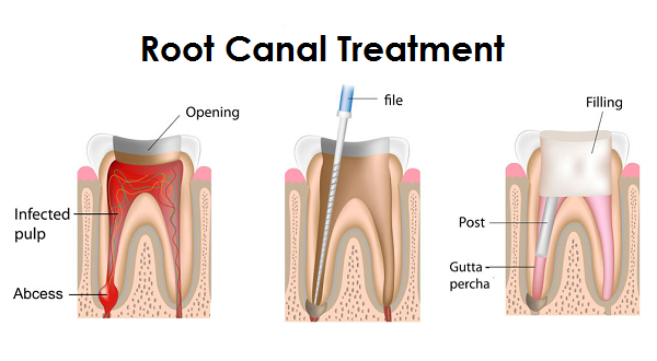 rootcanal